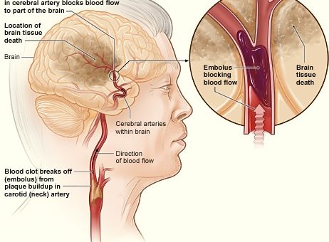 blood clot in an ischaemic stroke