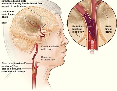 blood clot in an ischaemic stroke