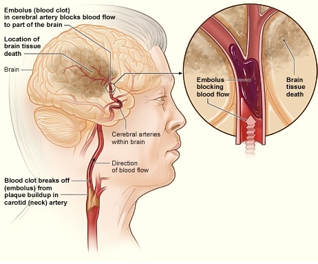 blood clot in an ischaemic stroke