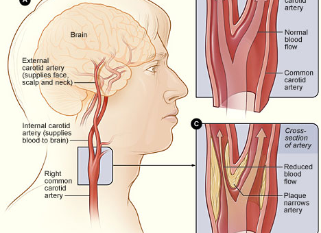 The right side of the human face in yellow colour and red color blood supply routes to the bain.
