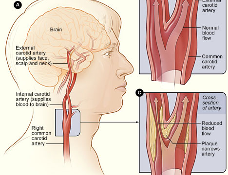 The right side of the human face in yellow colour and red color blood supply routes to the bain.